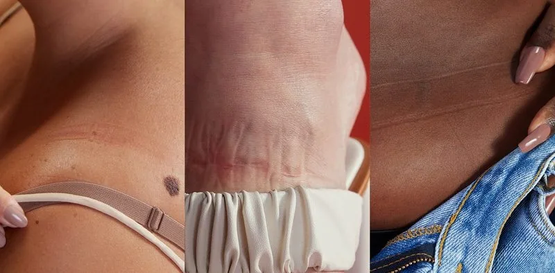 Marcas de roupa na pele